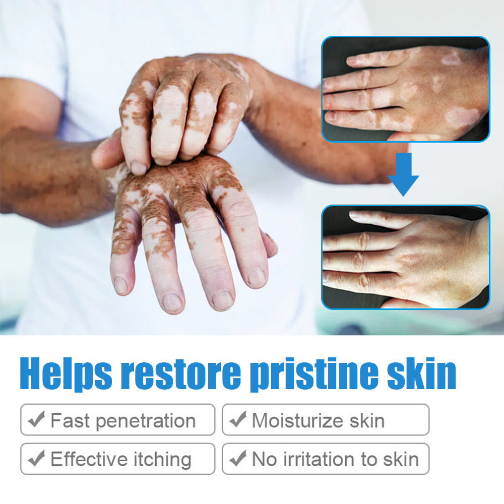 Lanemay Vitiligo Sweat Spotted Skin Care Nourishing Cream