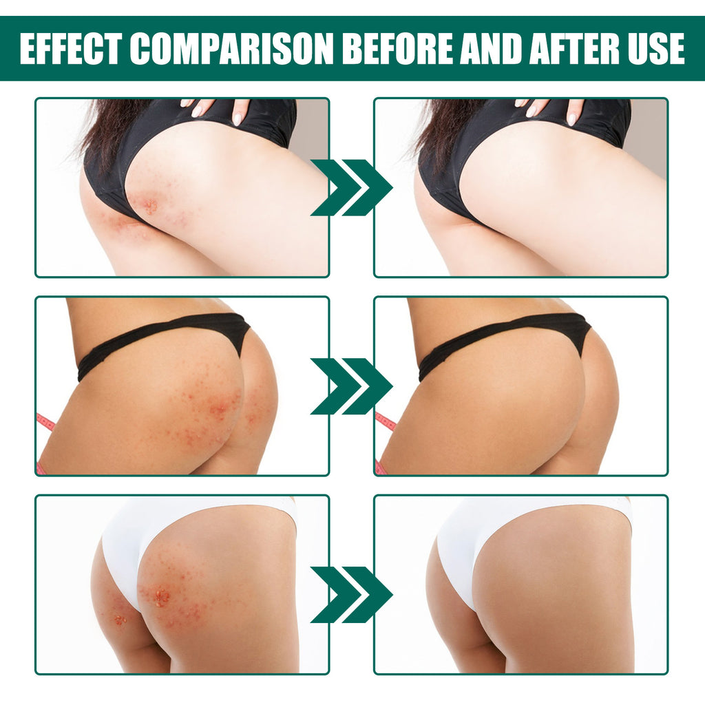 Jaysuing Hip Neck Cream Moisturizing Smallpox Diluting