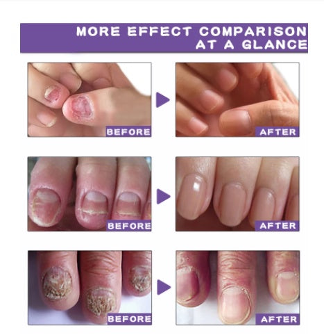 Saksraar Onychomycosis Liquid Nail Removal Cream Soft Liquid
