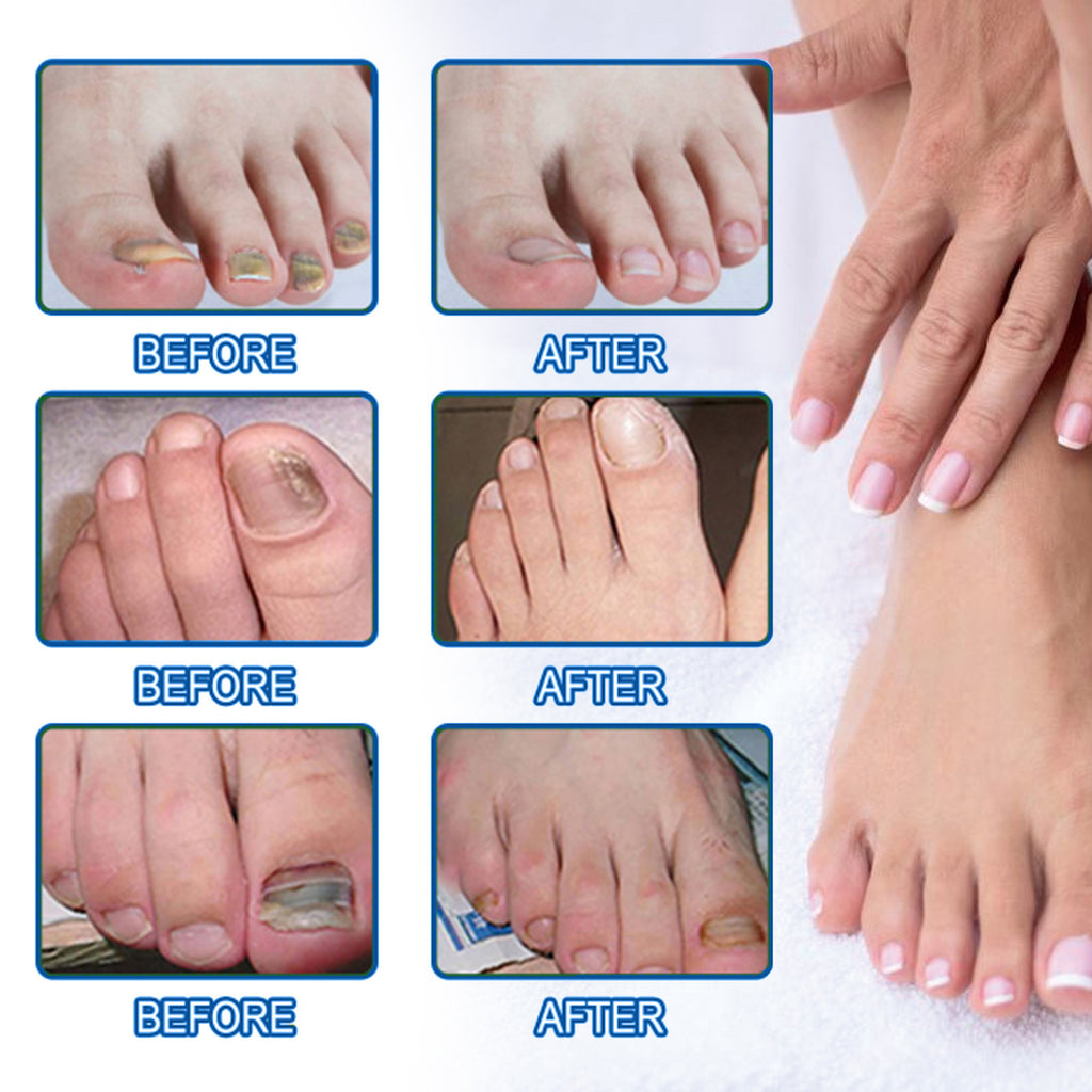Ximonth Nail Nursing Adhesive Bandage Nourishing