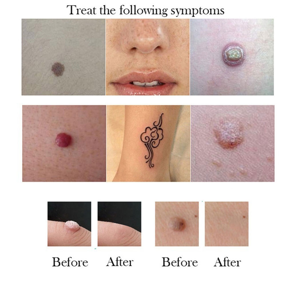 Naevus Mole removal cream
