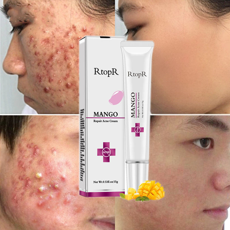 RtopR mango acne cream