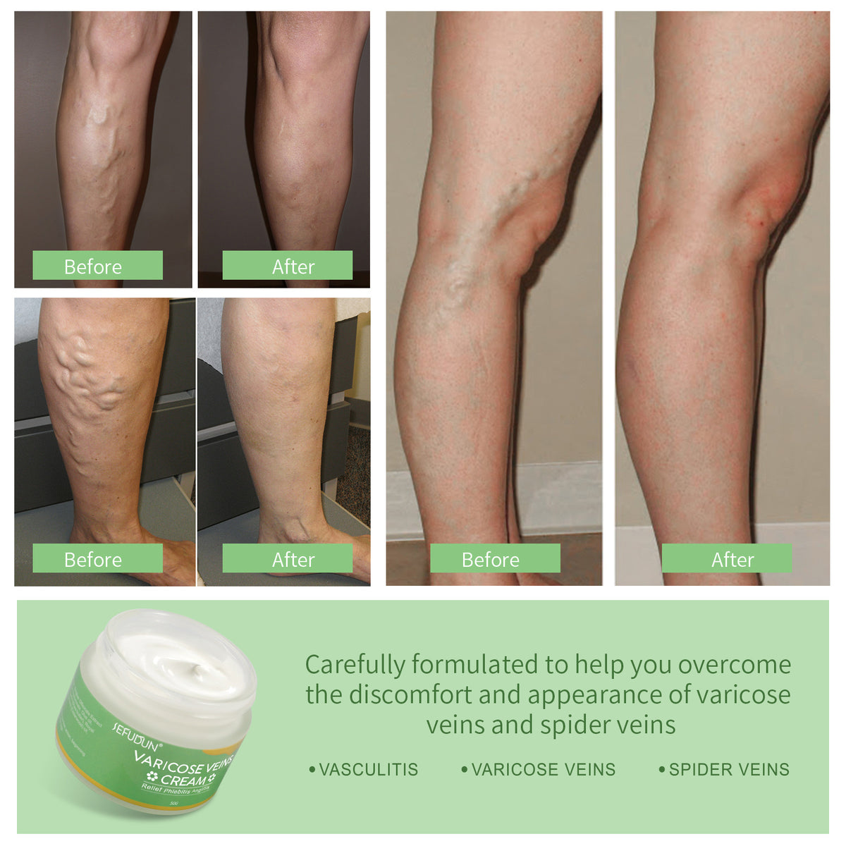 Sefudun Vein Cream Red Blood Streaks Repair Earthworm Leg Bruises Bulge Relief Pain Safflower Skin care lotion Varicose Cream