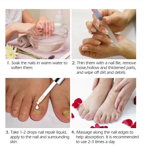 Saksraar Onychomycosis Liquid Nail Removal Cream Soft Liquid