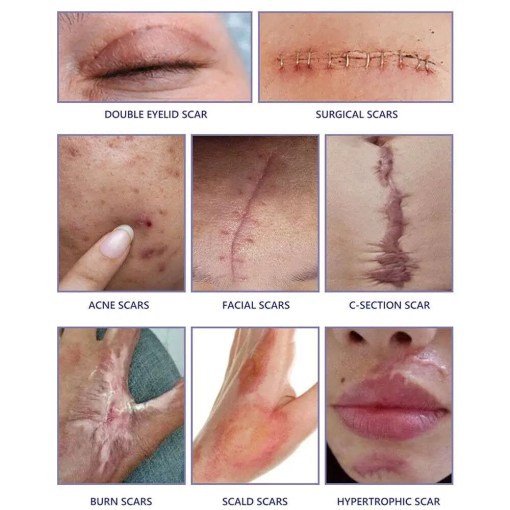 Sodsine Advanced Skin Mark Cream 20G