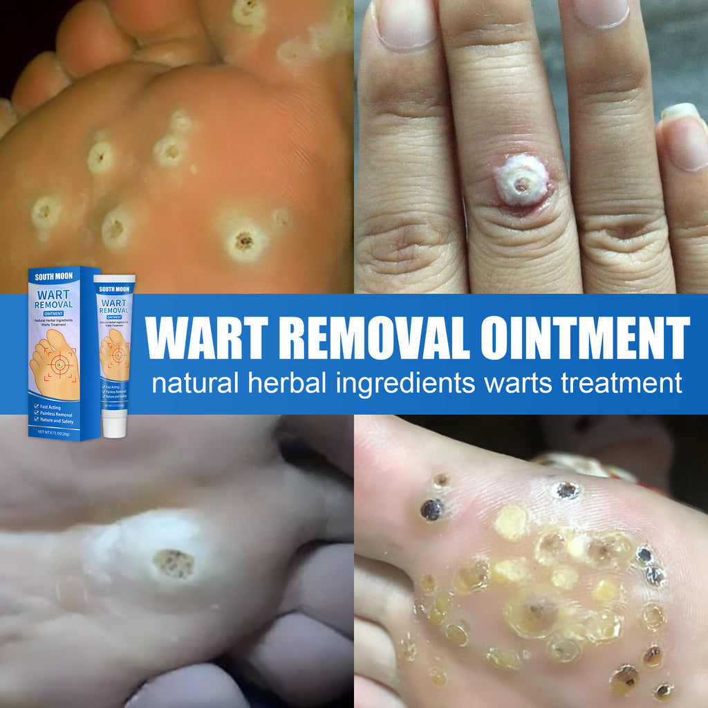 South Moon Remove Corns Cream To Smooth The Calluses