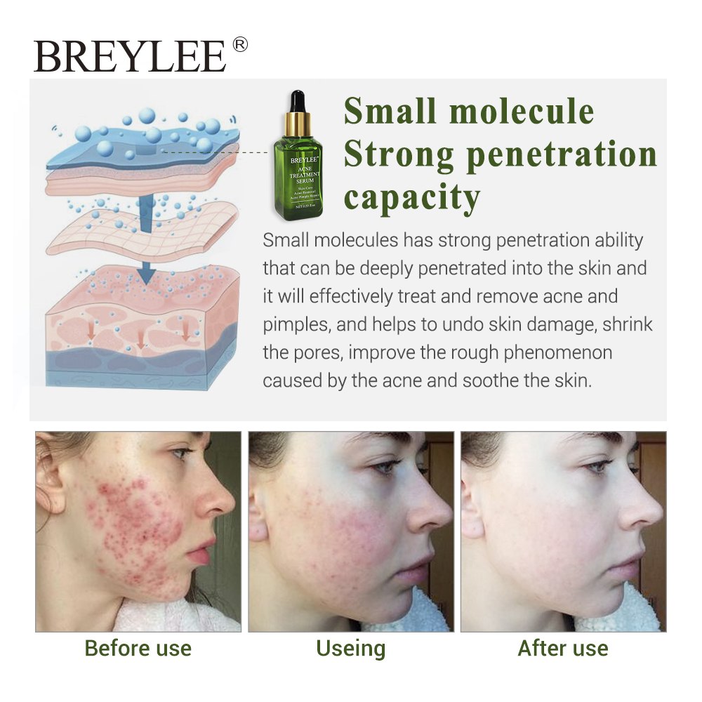 BREYLEE Blemish Care Serum Face Facial Clear Skin Skin Smoothing Cream Skin Care Brightening Nourishing Pimple Remover For Blemish