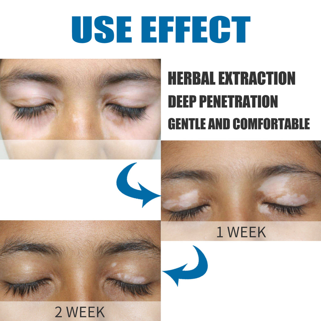 Vitiligo Nursing Efficacy On Skin Cream