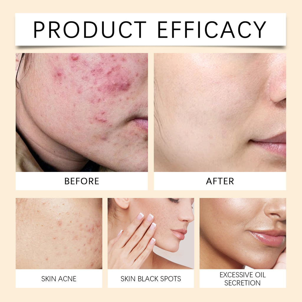 Hoygi Lighten Blemish Mark And Moisturize Face Cream