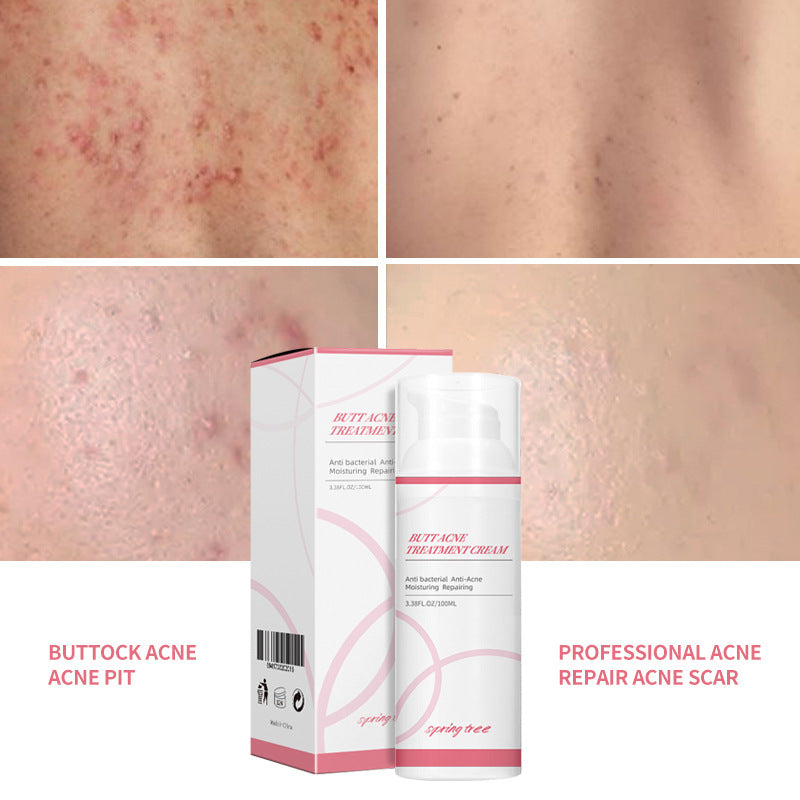 Spring Tree Blemish Cream For Buttocks Blemish Cream For Foreign Trade Only Amazon