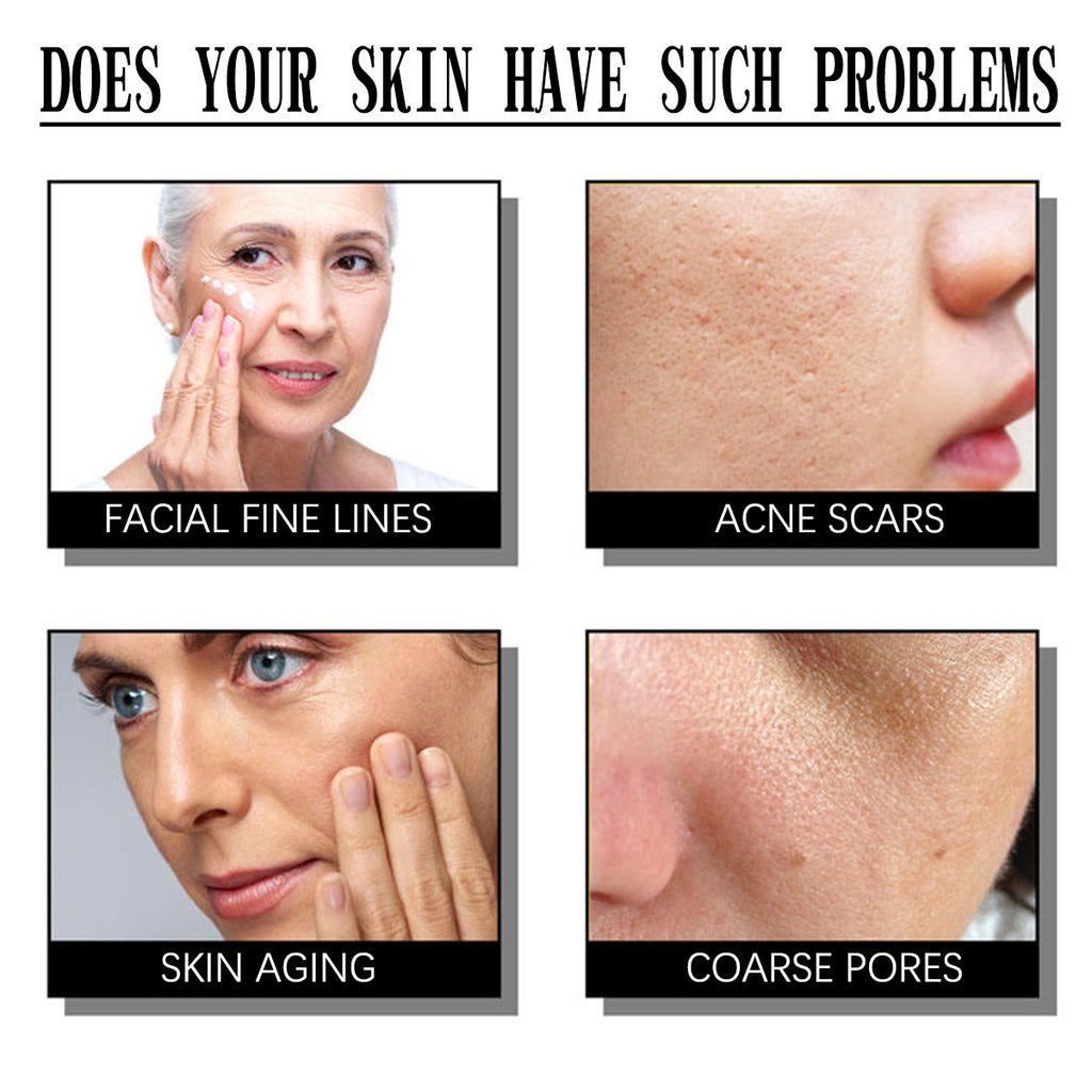 Aovanced Exfoliating Smallpox Diluting Salicylate Nourishing Moisturizing Cream