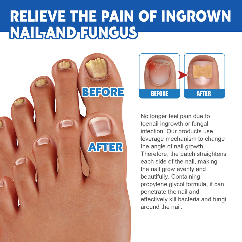 Jaysuing Nail Groove Nursing Adhesive Bandage Nourishing Thickened Gray Nail Soft Nail Correction