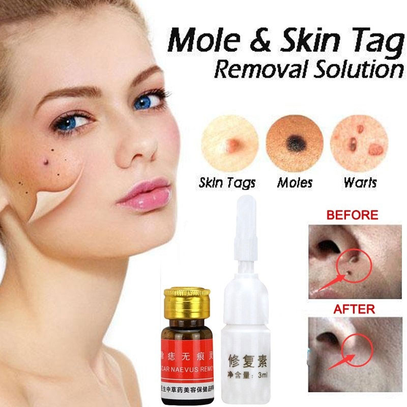 Naevus Mole removal cream