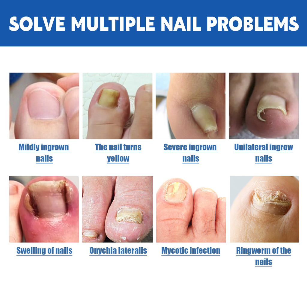Jaysuing Nail Groove Nursing Adhesive Bandage Nourishing Thickened Gray Nail Soft Nail Correction