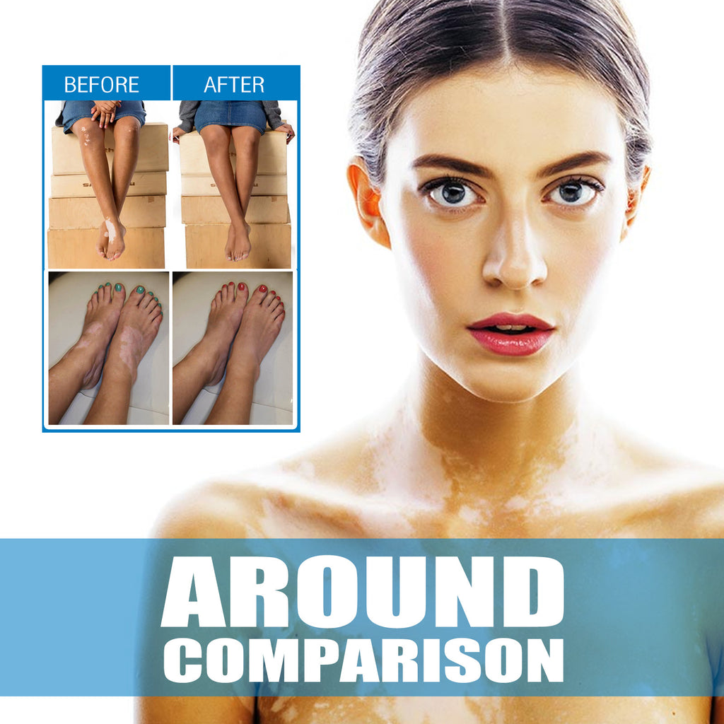 Vitiligo Nursing Efficacy On Skin Cream
