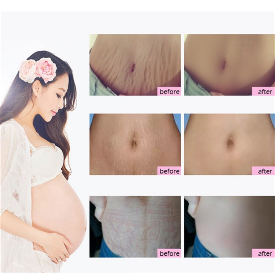 RtopR Natural Mild Non-irritating Mango Remove Stretch Mark Cream For Pregnancy Nourishing Skin Mark Slack Line Abdomen Stretch Marks Cream