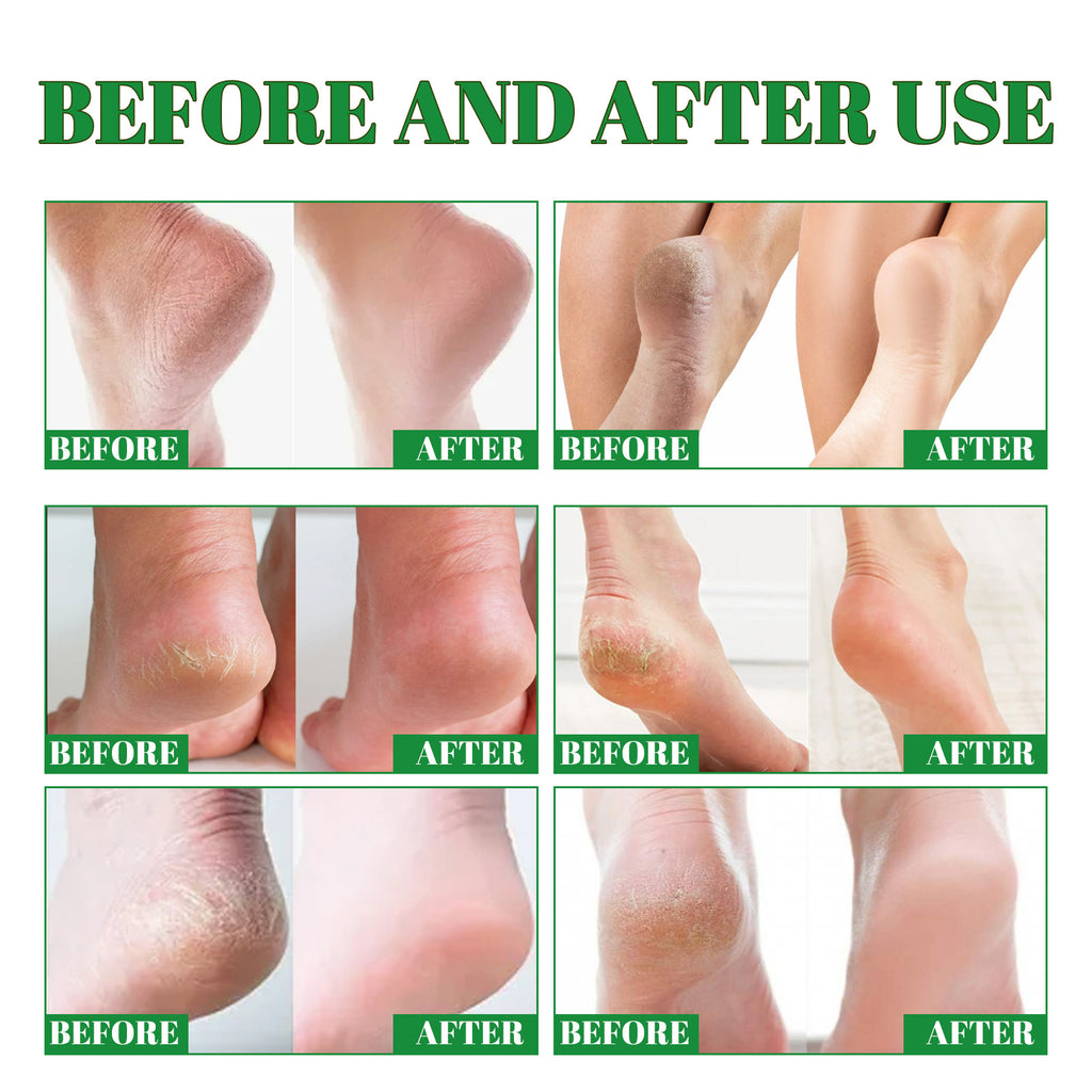 Eelhoe Deep Cleansing Foot Heel Moisturizing Cream