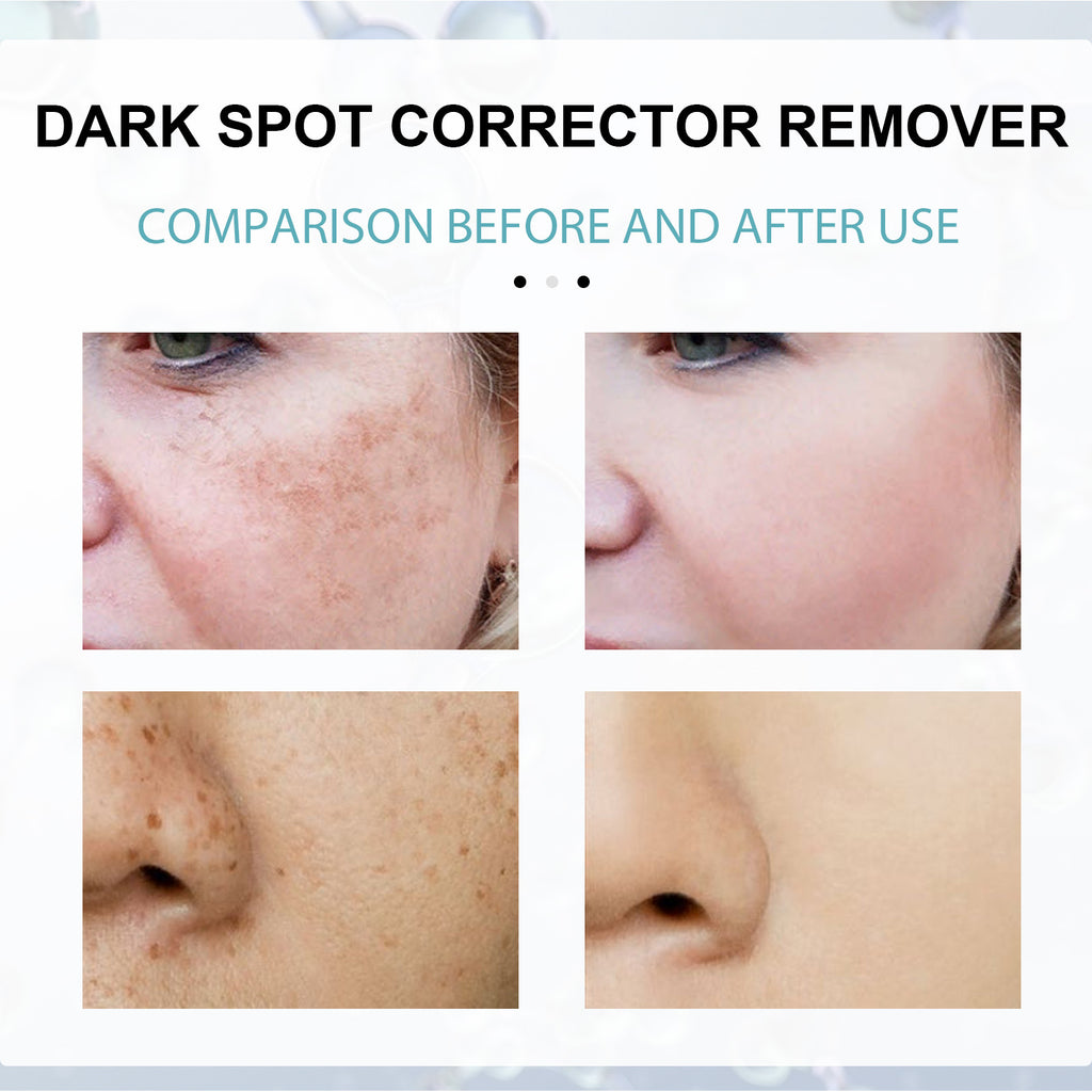 Eelhoe Facial Moisturizing Blackspot Removing Cream