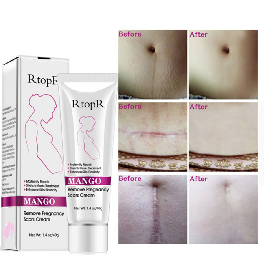 RtopR Natural Mild Non-irritating Mango Remove Stretch Mark Cream For Pregnancy Nourishing Skin Mark Slack Line Abdomen Stretch Marks Cream