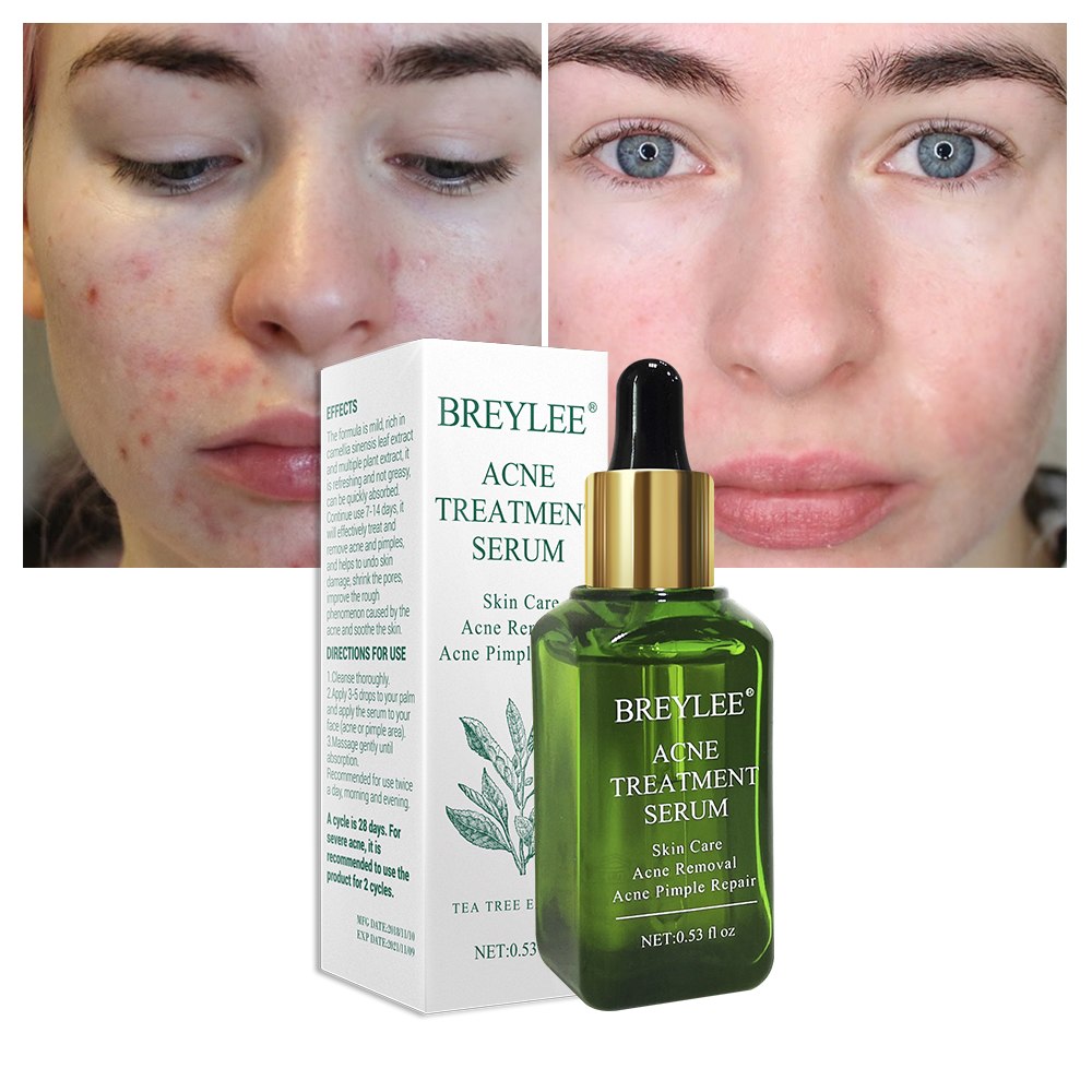 BREYLEE Blemish Care Serum Face Facial Clear Skin Skin Smoothing Cream Skin Care Brightening Nourishing Pimple Remover For Blemish