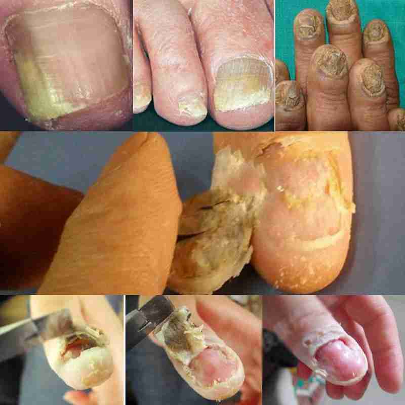 5 day Nail Care Nail Remove Nail Removal Cream Packet