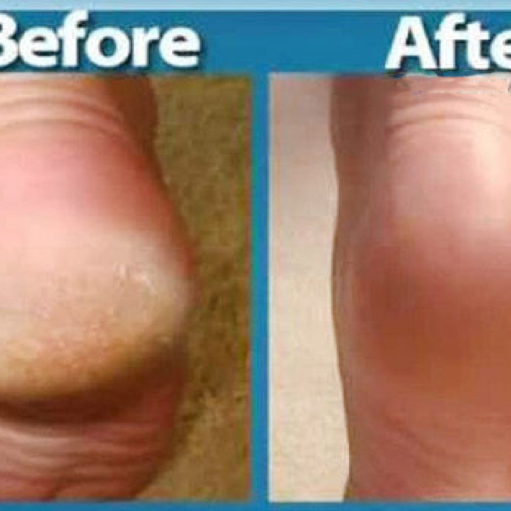 Heel Testic Massage Foot Crack And Apply Foot Cream