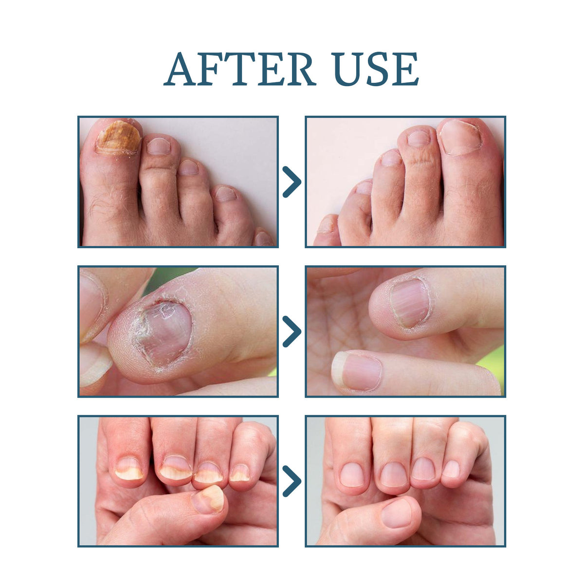 Ximonth Nail Nourishing Embedded Thickening Bright Nail