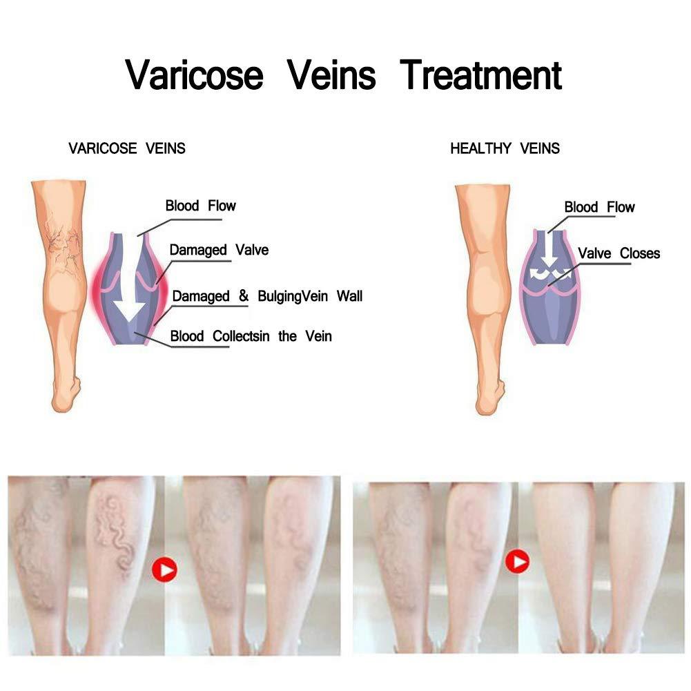 Vova Spider Leg Varicose Vein Nourishing Cream