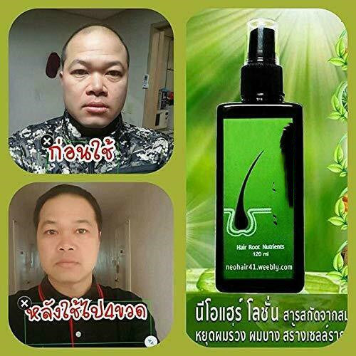 Neo Hair Lotion Removing Dandruff, Nourishinging And Nourishing Shampoo