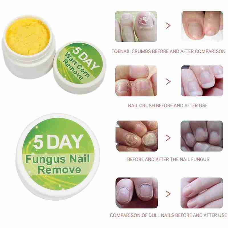 5 day Nail Care Nail Remove Nail Removal Cream Packet